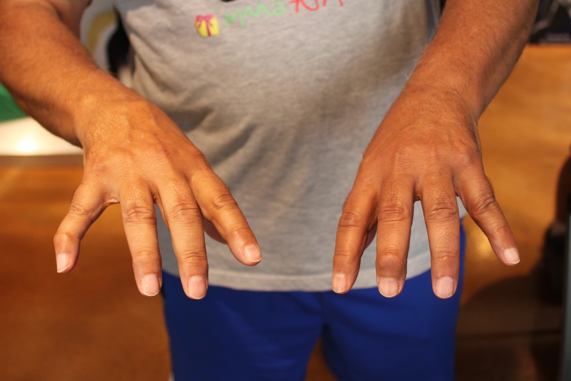 The Mangled History Of 16-Inch Softball Hands: Mallets, Swan Necks And Jersey Fingers